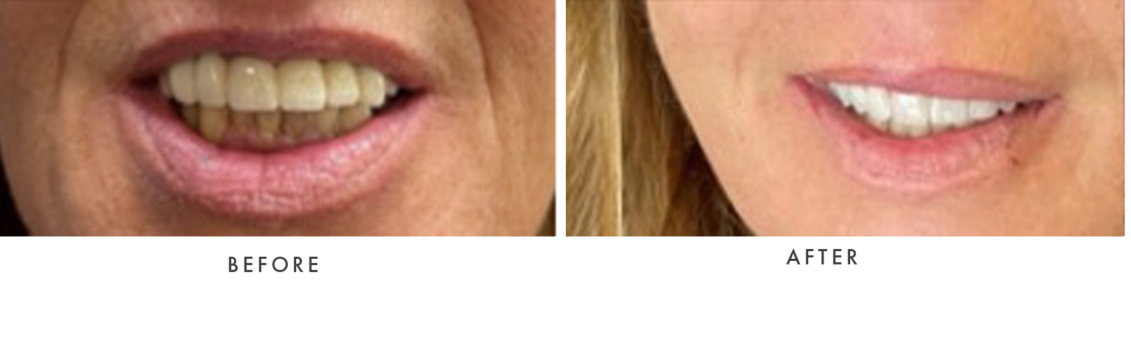 Teeth Whitening
