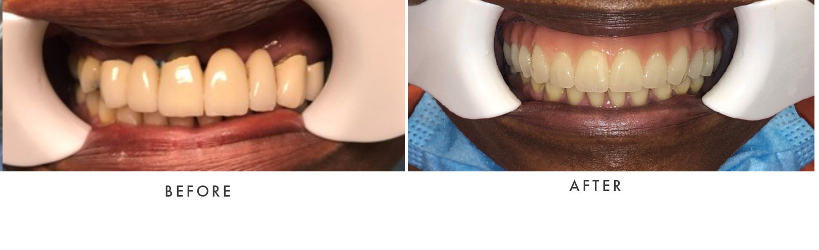 Porcelain Veneers