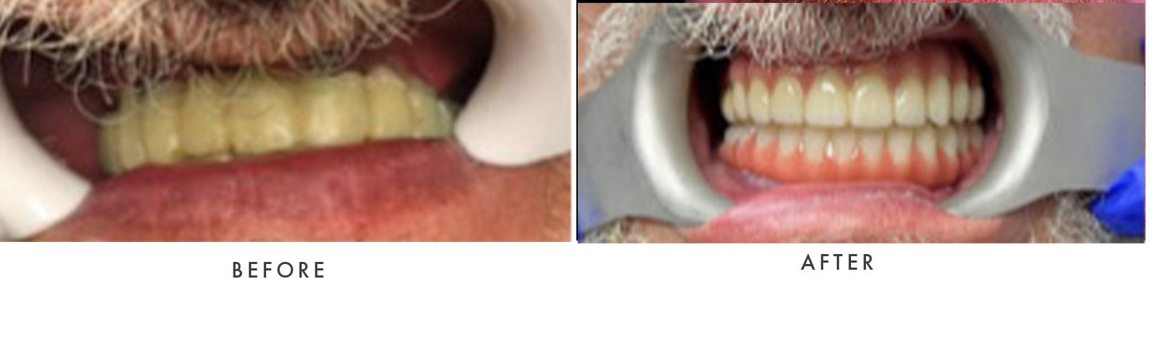Teeth Whitening