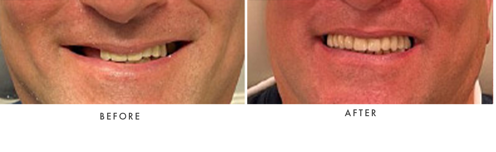 Full Mouth Dental Implants