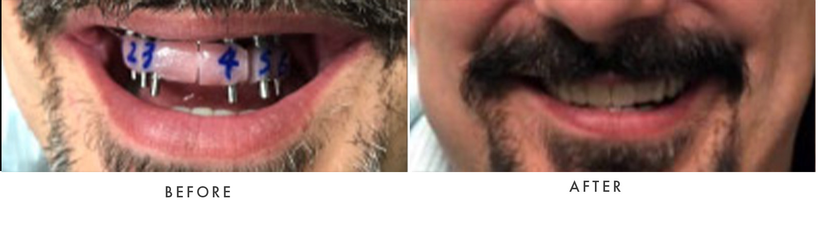 Full Mouth Dental Implants