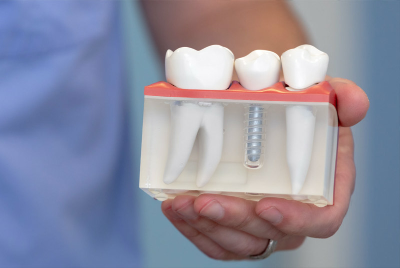 Dental implant example model