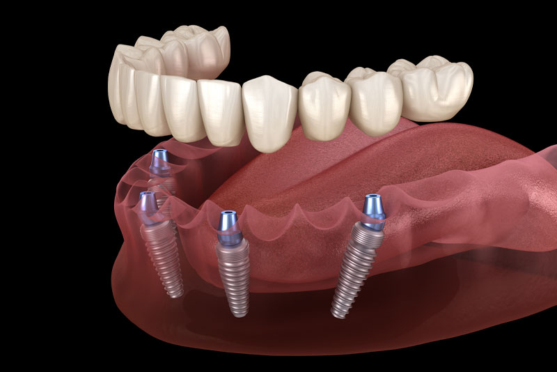 Full arch dental implants