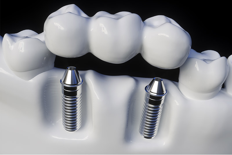 Implant example model