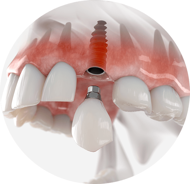 Dental implant example model