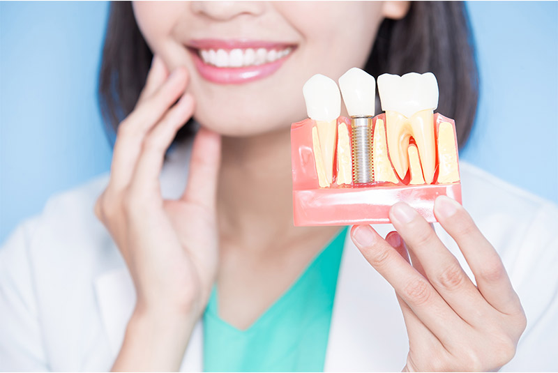 Dental implant example model