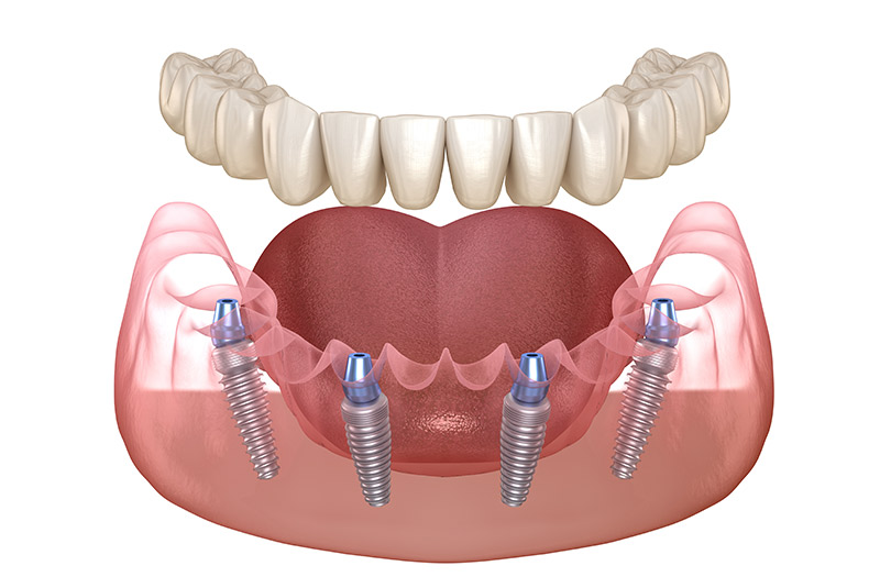 Full mouth dental implant example model